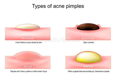 papule perlée|Couronne perlée ou papules nacrées, ensemble de boutons。